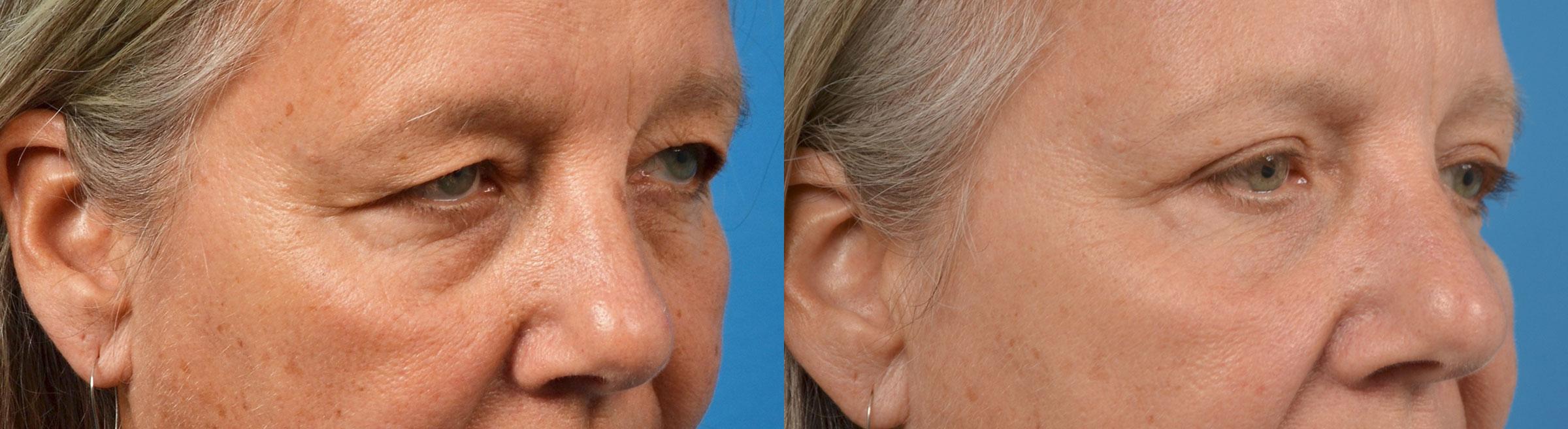 Eyelid Surgery Before & After Gallery - Patient 250985 - Image 2