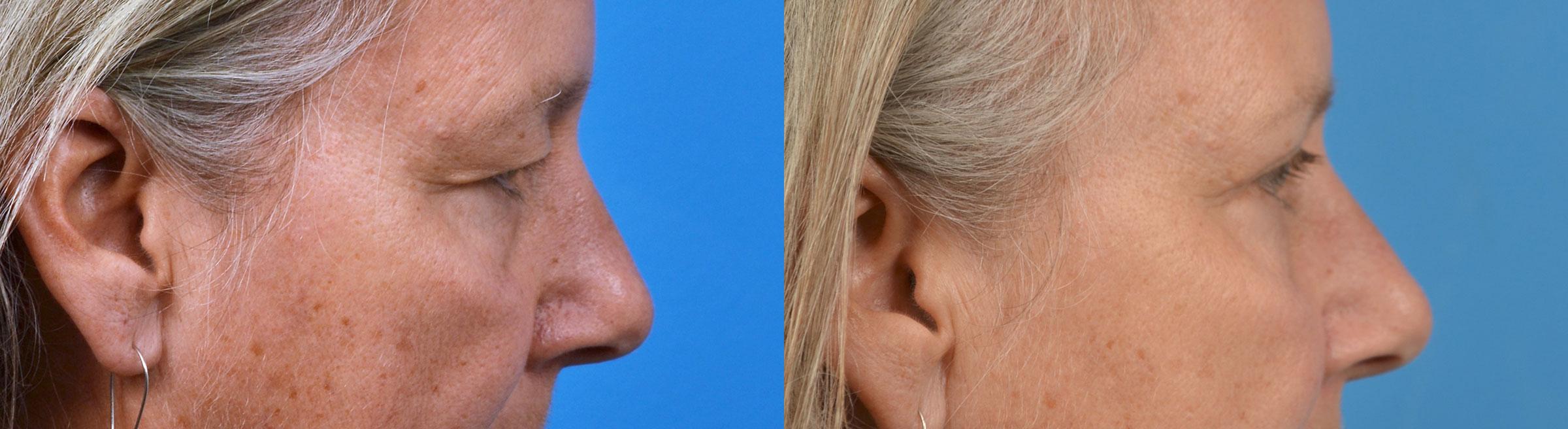 Eyelid Surgery Before & After Gallery - Patient 250985 - Image 3