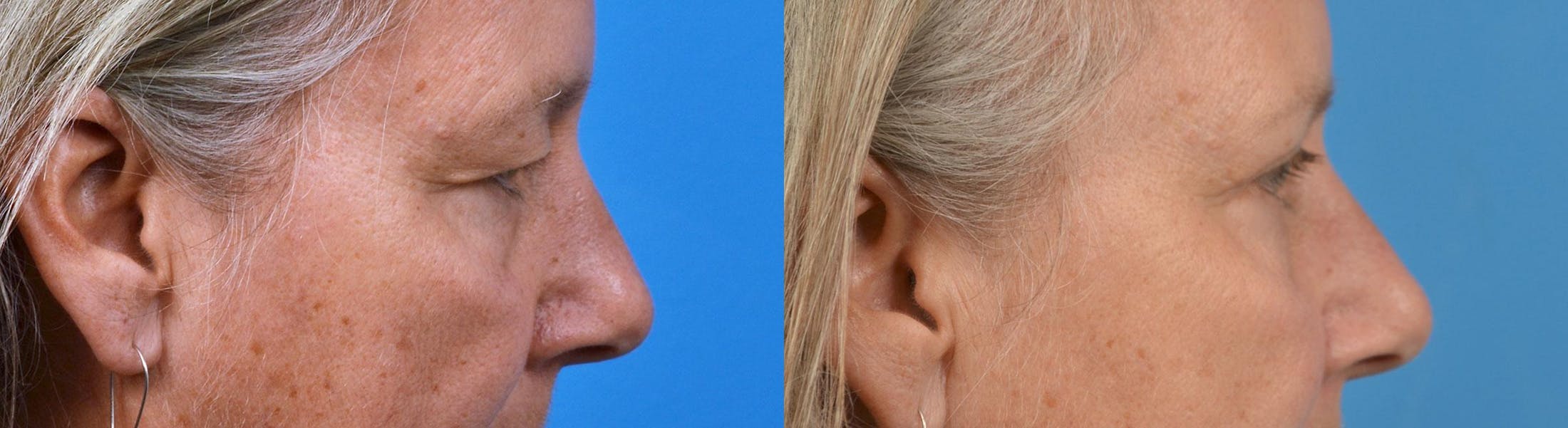 Eyelid Surgery Before & After Gallery - Patient 122444591 - Image 3