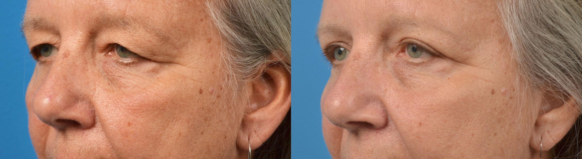 Eyelid Surgery Before & After Gallery - Patient 250985 - Image 4