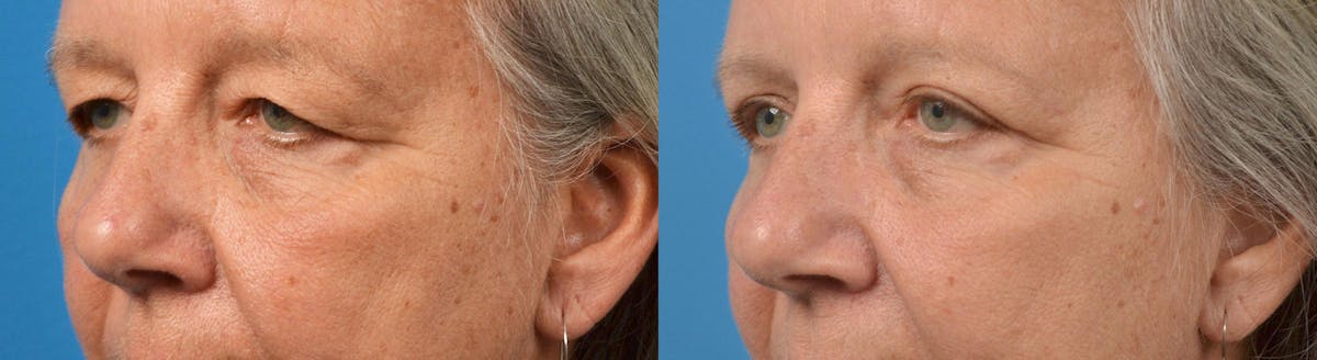 Eyelid Surgery Before & After Gallery - Patient 122444591 - Image 4