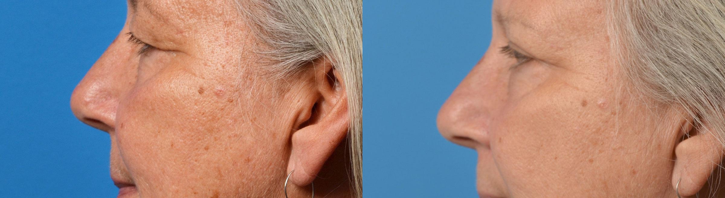 Eyelid Surgery Before & After Gallery - Patient 250985 - Image 5