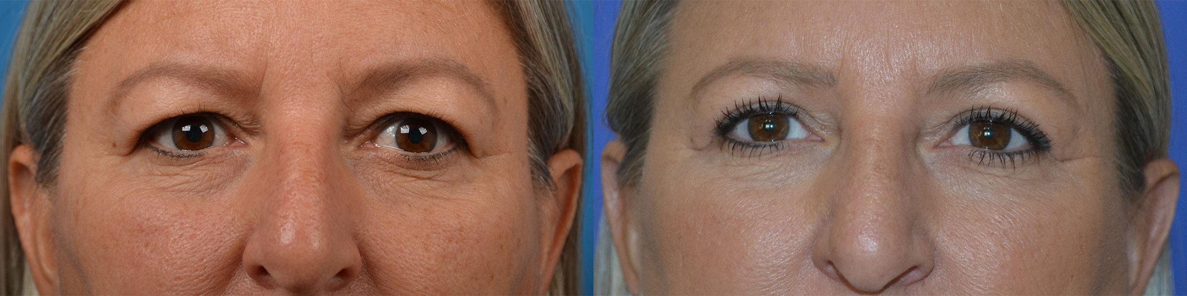 Eyelid Surgery Before & After Gallery - Patient 244641 - Image 1