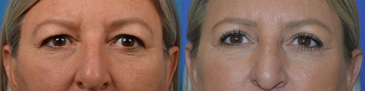 Eyelid Surgery Before & After Gallery - Patient 122444598 - Image 1