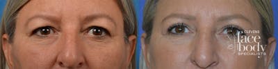 Eyelid Surgery Before & After Gallery - Patient 244641 - Image 1