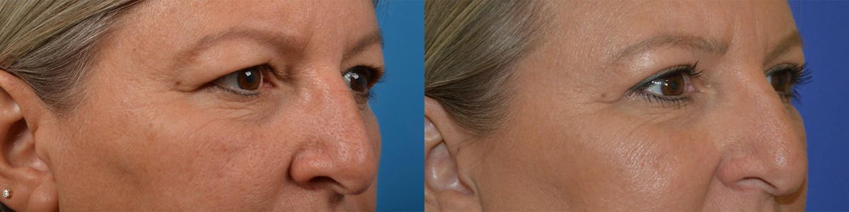 Eyelid Surgery Before & After Gallery - Patient 122444598 - Image 2