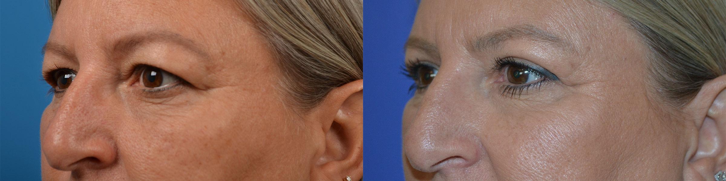 Eyelid Surgery Before & After Gallery - Patient 244641 - Image 3