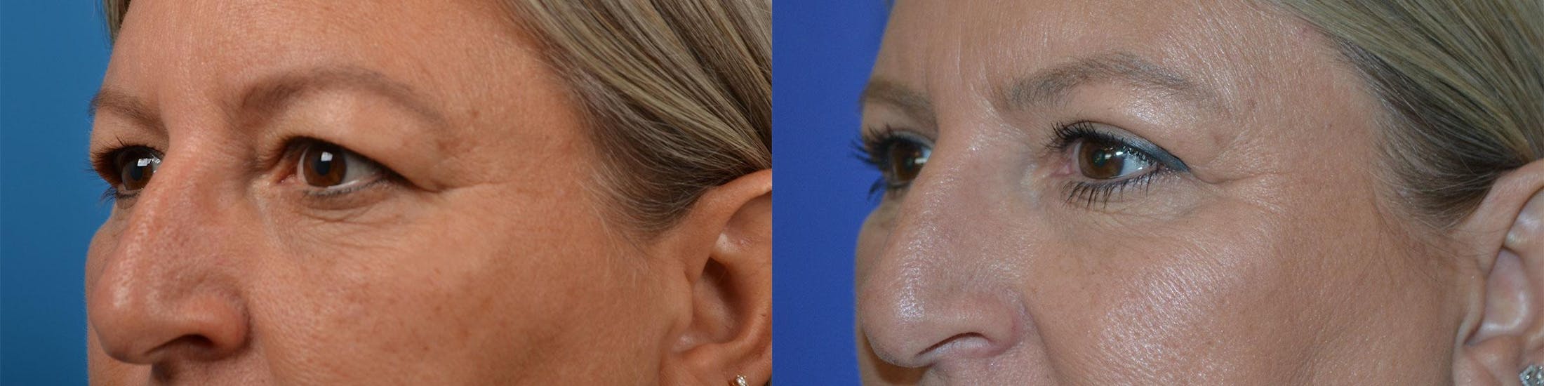Eyelid Surgery Before & After Gallery - Patient 122444598 - Image 3