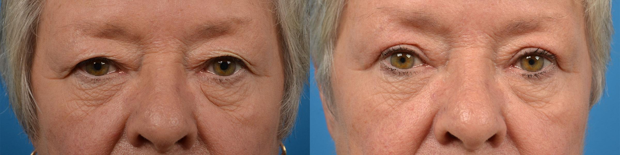 Eyelid Surgery Before & After Gallery - Patient 160992 - Image 1