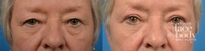 Eyelid Surgery Before & After Gallery - Patient 160992 - Image 1