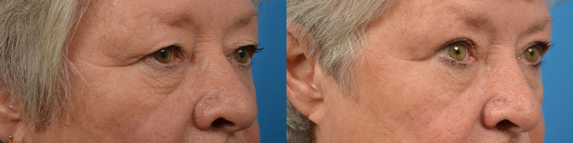 Eyelid Surgery Before & After Gallery - Patient 160992 - Image 2