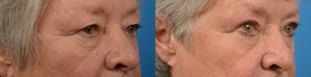 Eyelid Surgery Before & After Gallery - Patient 122444605 - Image 2