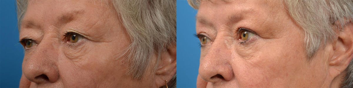 Eyelid Surgery Before & After Gallery - Patient 122444605 - Image 3