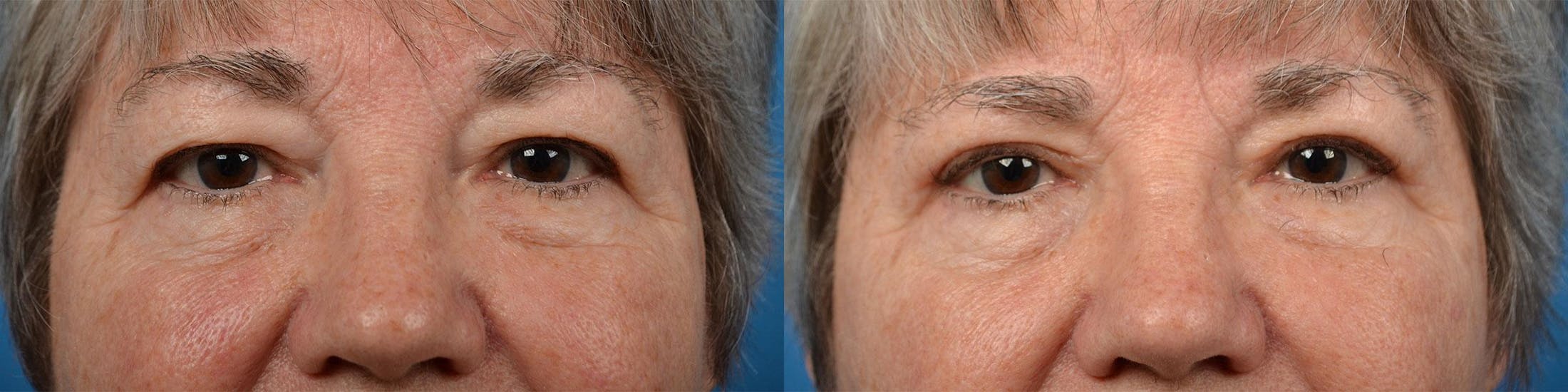 Eyelid Surgery Before & After Gallery - Patient 122444606 - Image 1