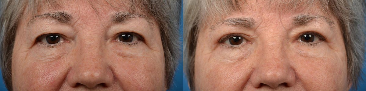 Eyelid Surgery Before & After Gallery - Patient 122444606 - Image 1