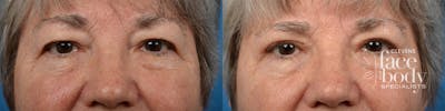 Eyelid Surgery Before & After Gallery - Patient 404029 - Image 1