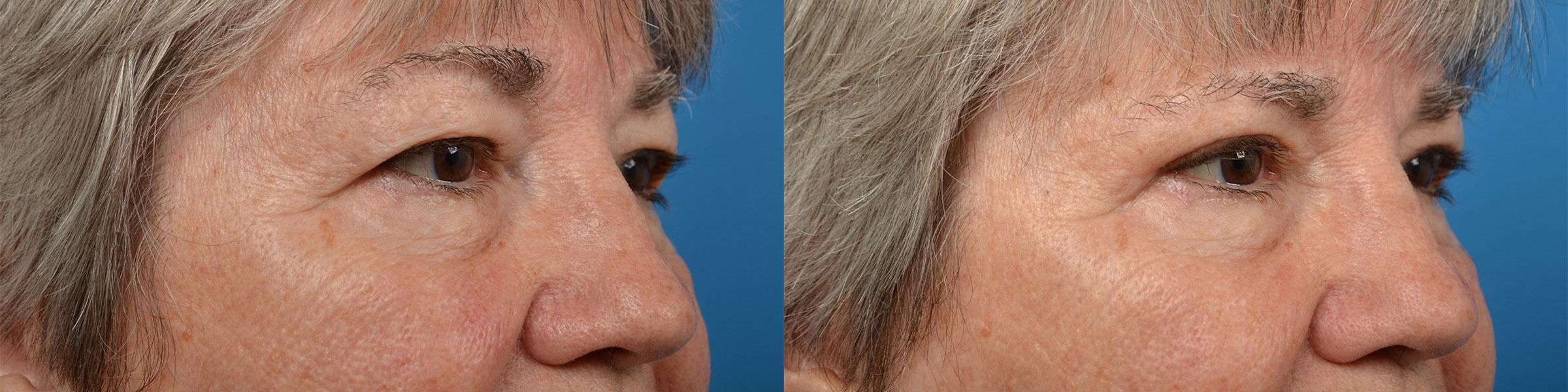 Eyelid Surgery Before & After Gallery - Patient 404029 - Image 2