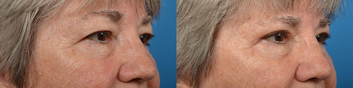 Eyelid Surgery Before & After Gallery - Patient 122444606 - Image 2