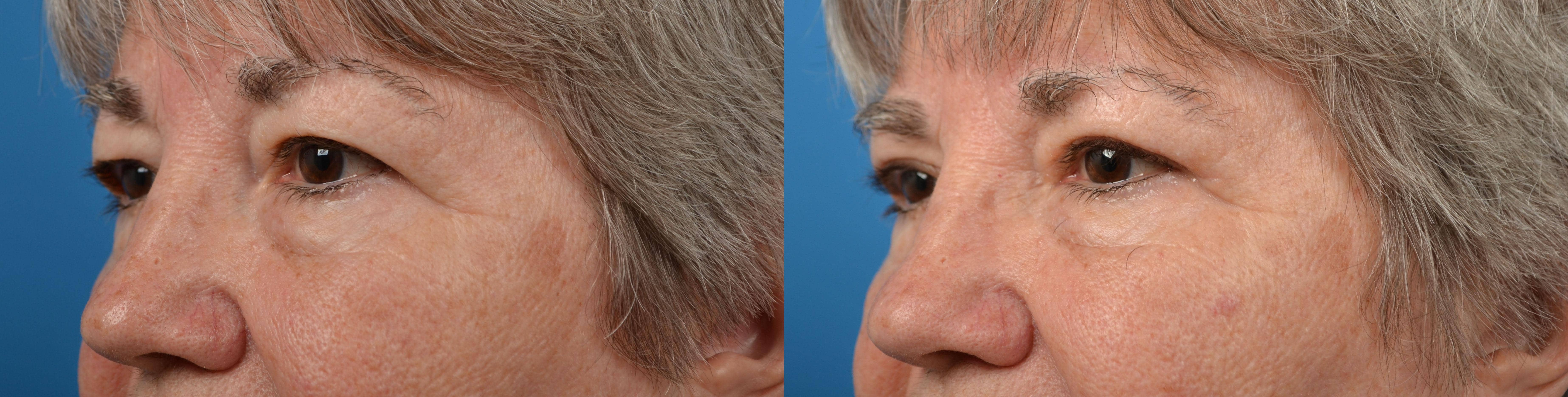 Eyelid Surgery Before & After Gallery - Patient 404029 - Image 3