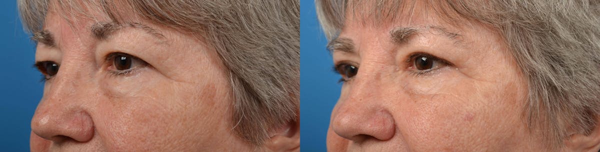 Eyelid Surgery Before & After Gallery - Patient 122444606 - Image 3