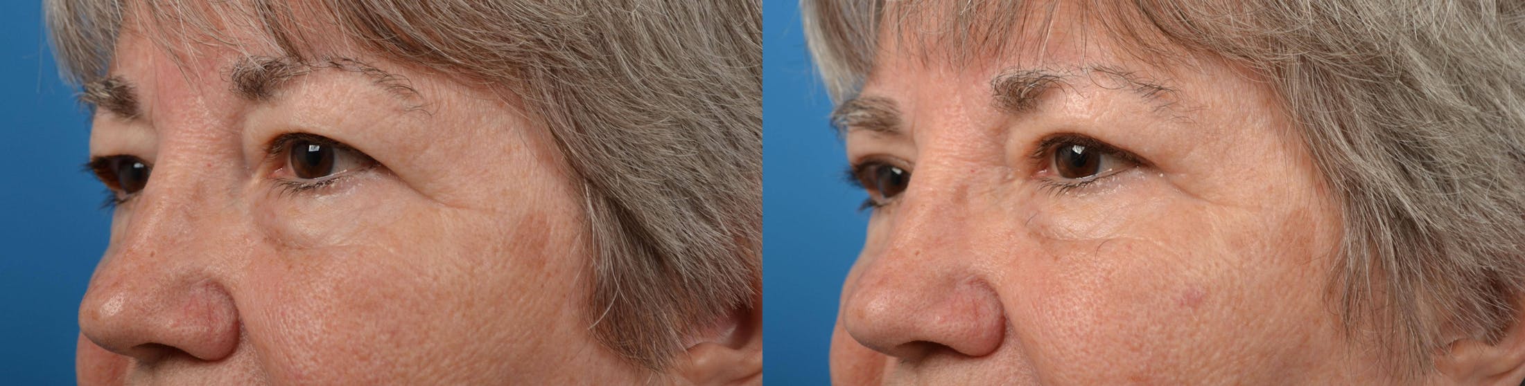 Eyelid Surgery Gallery - Patient 122444606 - Image 3