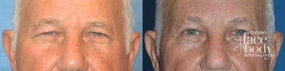 Eyelid Surgery Before & After Gallery - Patient 221341 - Image 1