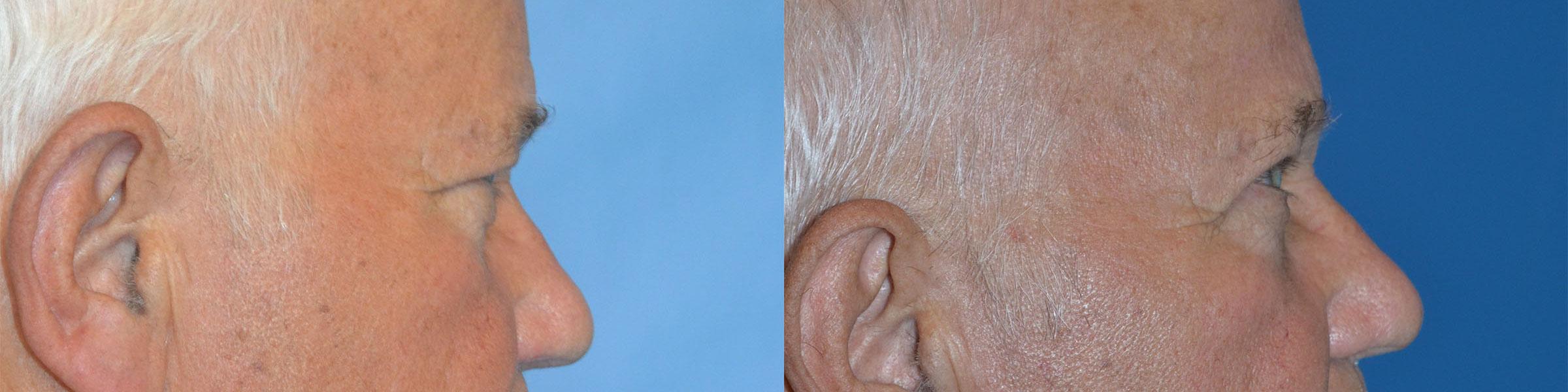 Eyelid Surgery Before & After Gallery - Patient 221341 - Image 2