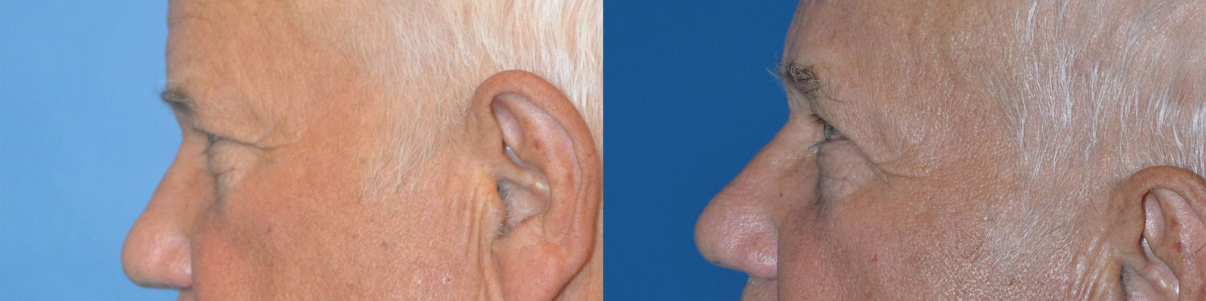 Eyelid Surgery Before & After Gallery - Patient 221341 - Image 4