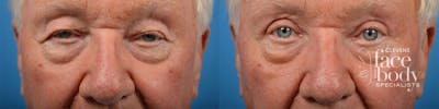 Eyelid Surgery Before & After Gallery - Patient 192923 - Image 1