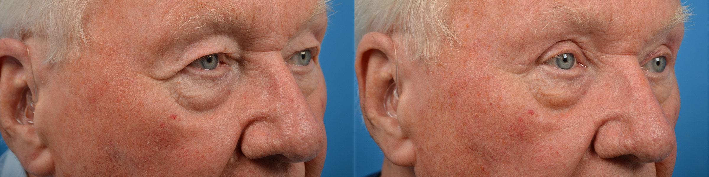 Eyelid Surgery Before & After Gallery - Patient 192923 - Image 2