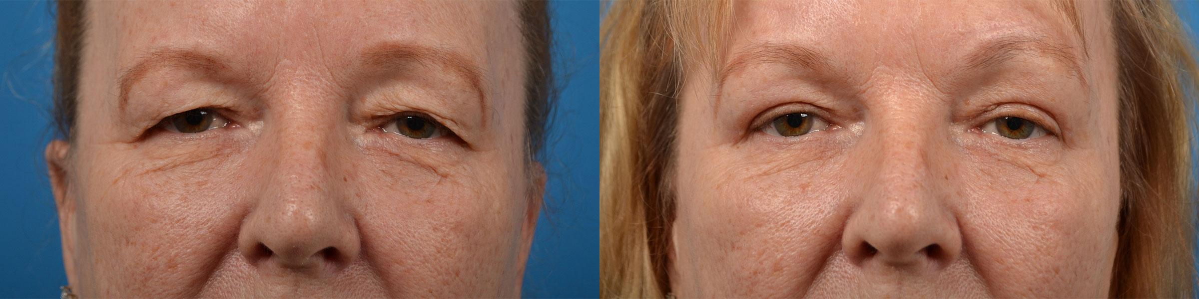 Eyelid Surgery Before & After Gallery - Patient 236654 - Image 1