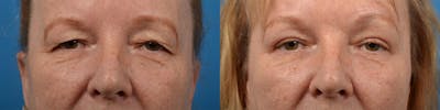 Eyelid Surgery Before & After Gallery - Patient 122444616 - Image 1