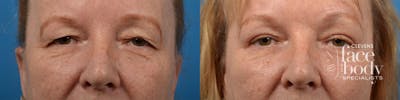 Eyelid Surgery Before & After Gallery - Patient 236654 - Image 1