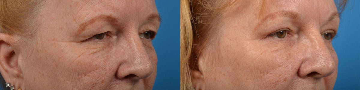 Eyelid Surgery Before & After Gallery - Patient 122444616 - Image 2