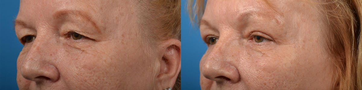 Eyelid Surgery Before & After Gallery - Patient 122444616 - Image 3