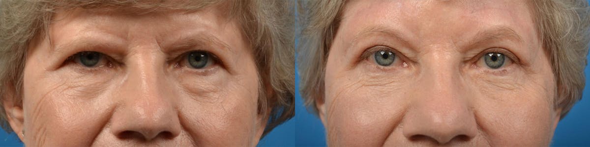 Eyelid Surgery Before & After Gallery - Patient 122444625 - Image 1