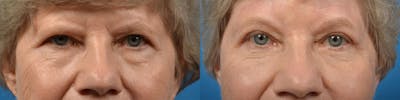 Eyelid Surgery Before & After Gallery - Patient 122444625 - Image 1