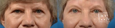 Eyelid Surgery Before & After Gallery - Patient 143915 - Image 1