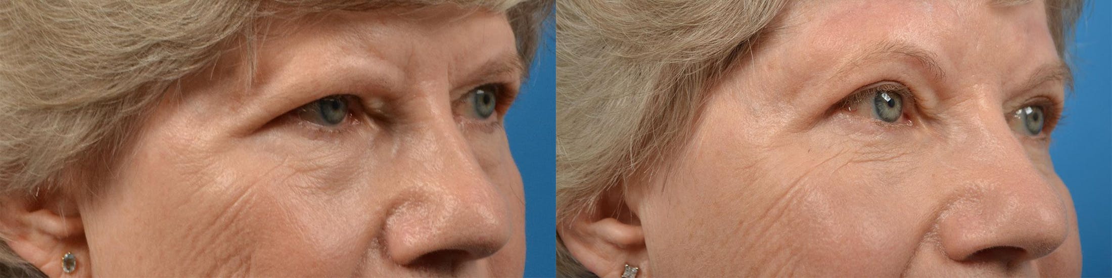 Eyelid Surgery Before & After Gallery - Patient 122444625 - Image 2