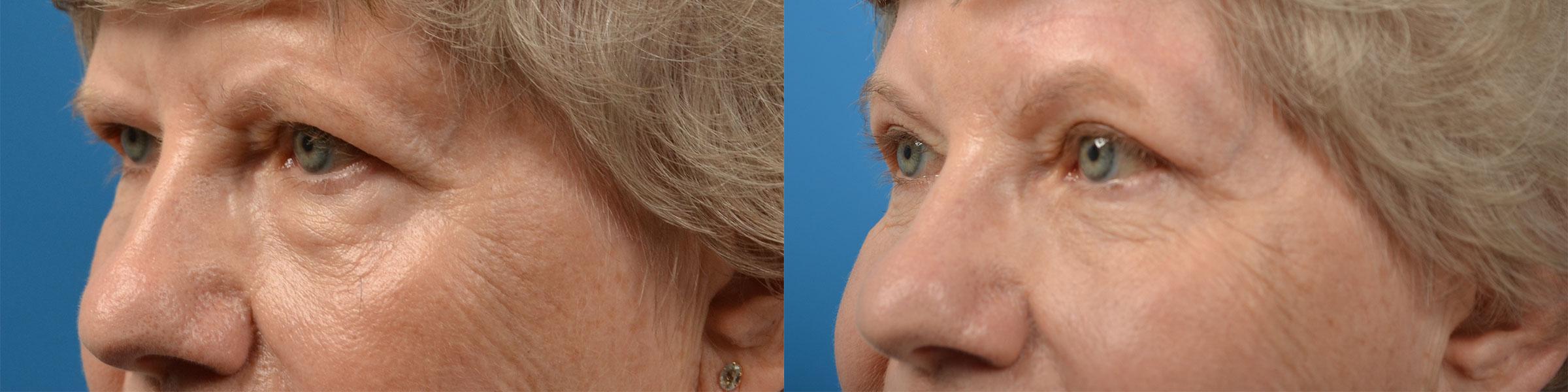 Eyelid Surgery Before & After Gallery - Patient 143915 - Image 3