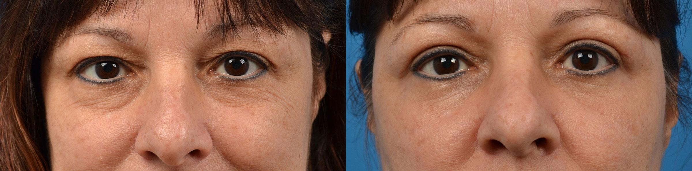Eyelid Surgery Before & After Gallery - Patient 184411 - Image 1