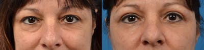 Eyelid Surgery Before & After Gallery - Patient 122444627 - Image 1