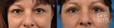 Eyelid Surgery Before & After Gallery - Patient 184411 - Image 1