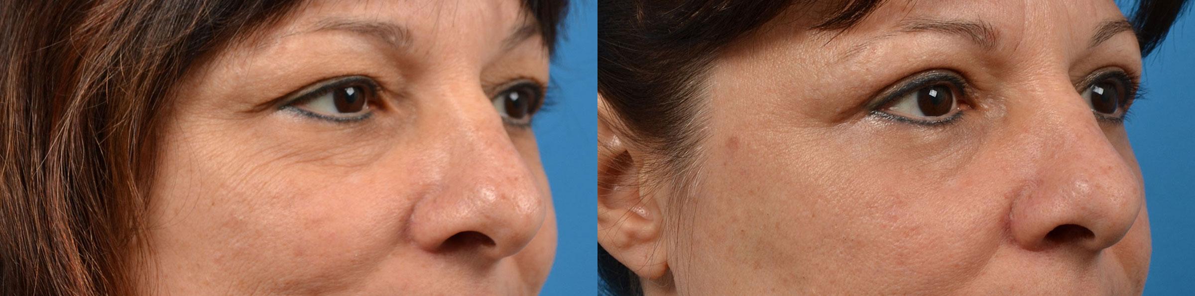 Eyelid Surgery Before & After Gallery - Patient 184411 - Image 2