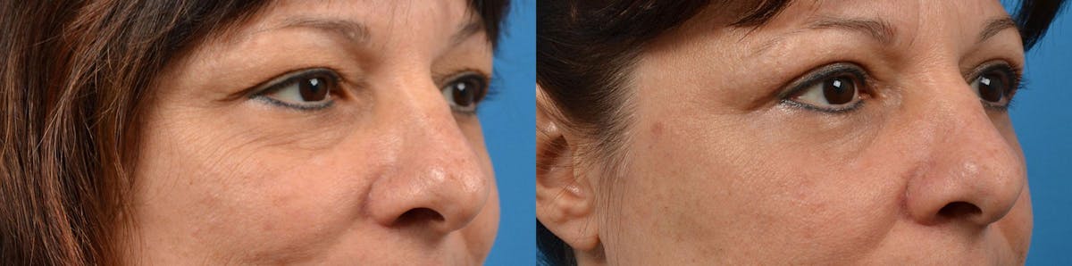 Eyelid Surgery Before & After Gallery - Patient 122444627 - Image 2