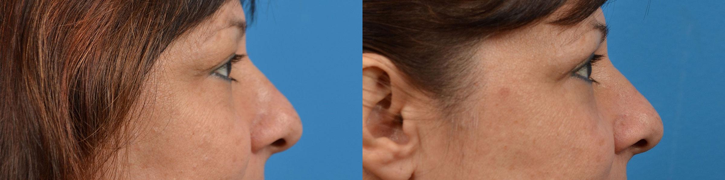 Eyelid Surgery Before & After Gallery - Patient 184411 - Image 3