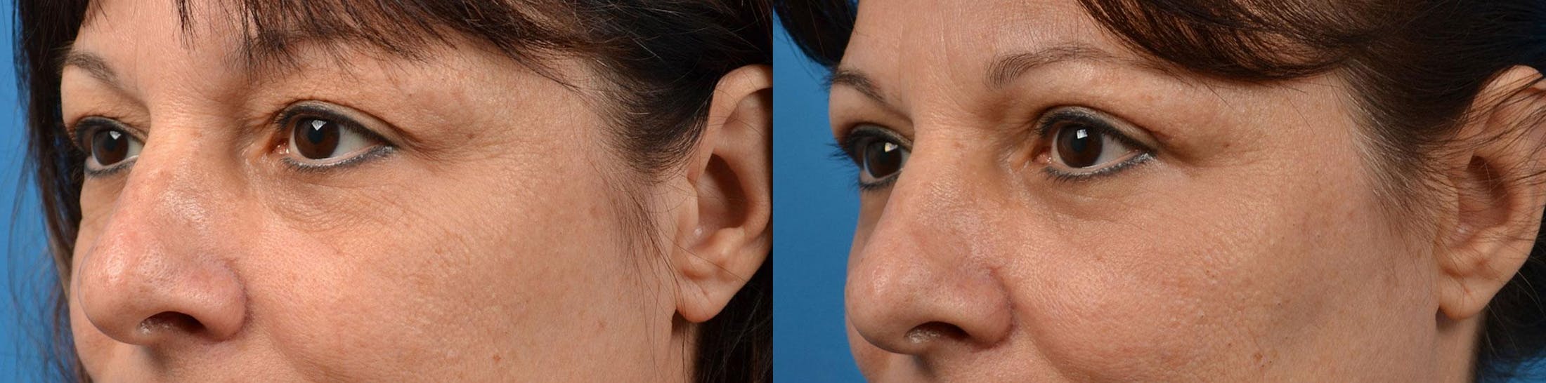 Eyelid Surgery Before & After Gallery - Patient 122444627 - Image 4