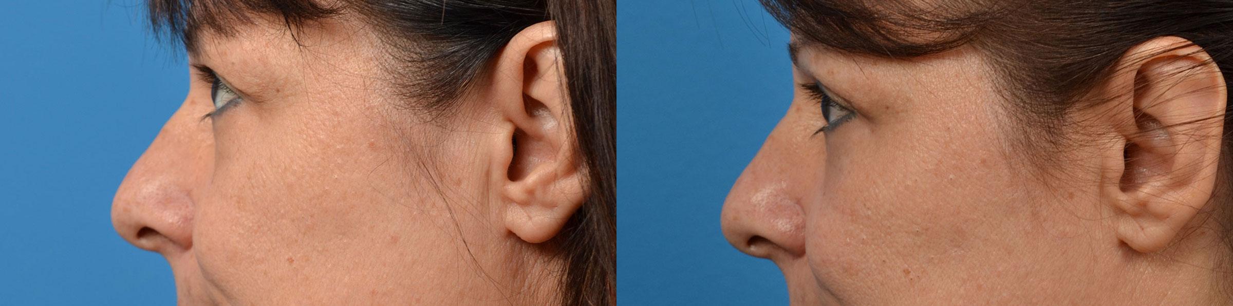 Eyelid Surgery Before & After Gallery - Patient 184411 - Image 5