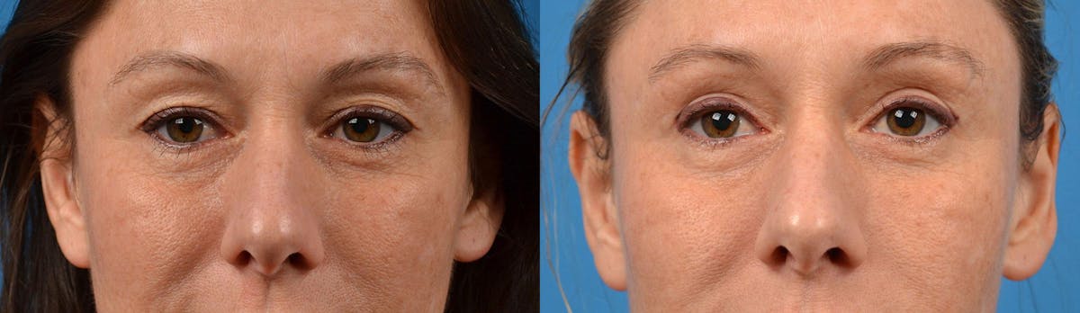 Eyelid Surgery Before & After Gallery - Patient 122444629 - Image 1