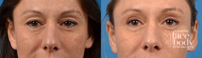 Eyelid Surgery Before & After Gallery - Patient 207373 - Image 1